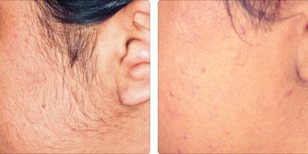 hair-removal-laser-1