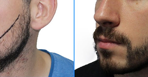 تقویت و کاشت مو، ریش و ابرو